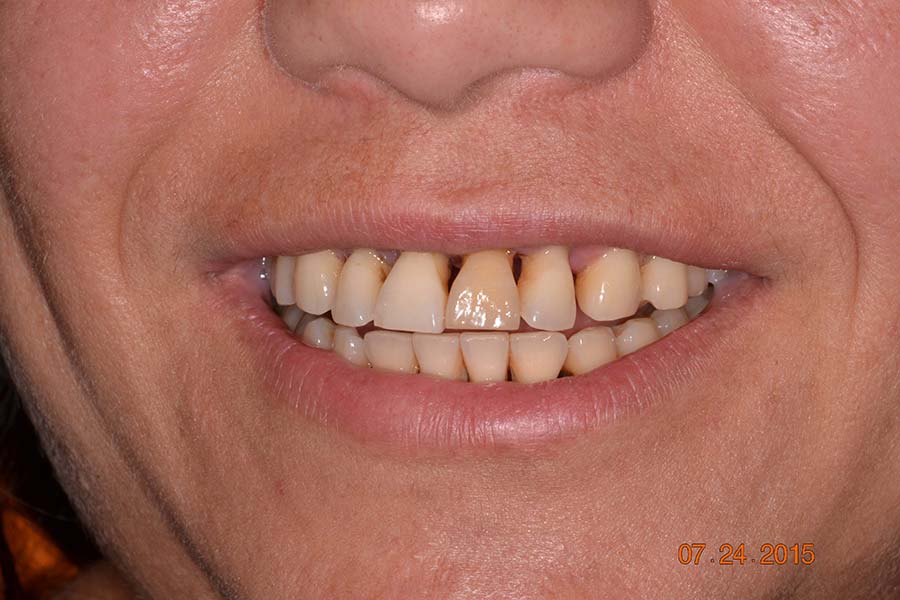 SAll-on-4 Implant dentures before and after photos